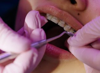 6 Ways to Ensure Long-Term Stability after Braces Removal Braces
