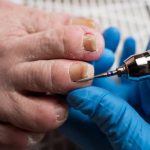 Is Ingrown Toenail Removal Madison AL a Permanent Fix? ingrown toenail removal