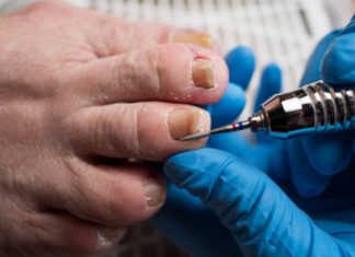 Is Ingrown Toenail Removal Madison AL a Permanent Fix? ingrown toenail removal