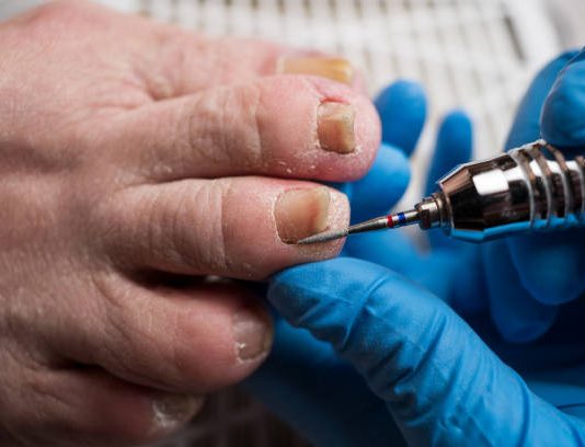 Is Ingrown Toenail Removal Madison AL a Permanent Fix? ingrown toenail removal