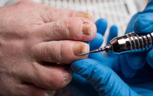 Is Ingrown Toenail Removal Madison AL a Permanent Fix? ingrown toenail removal